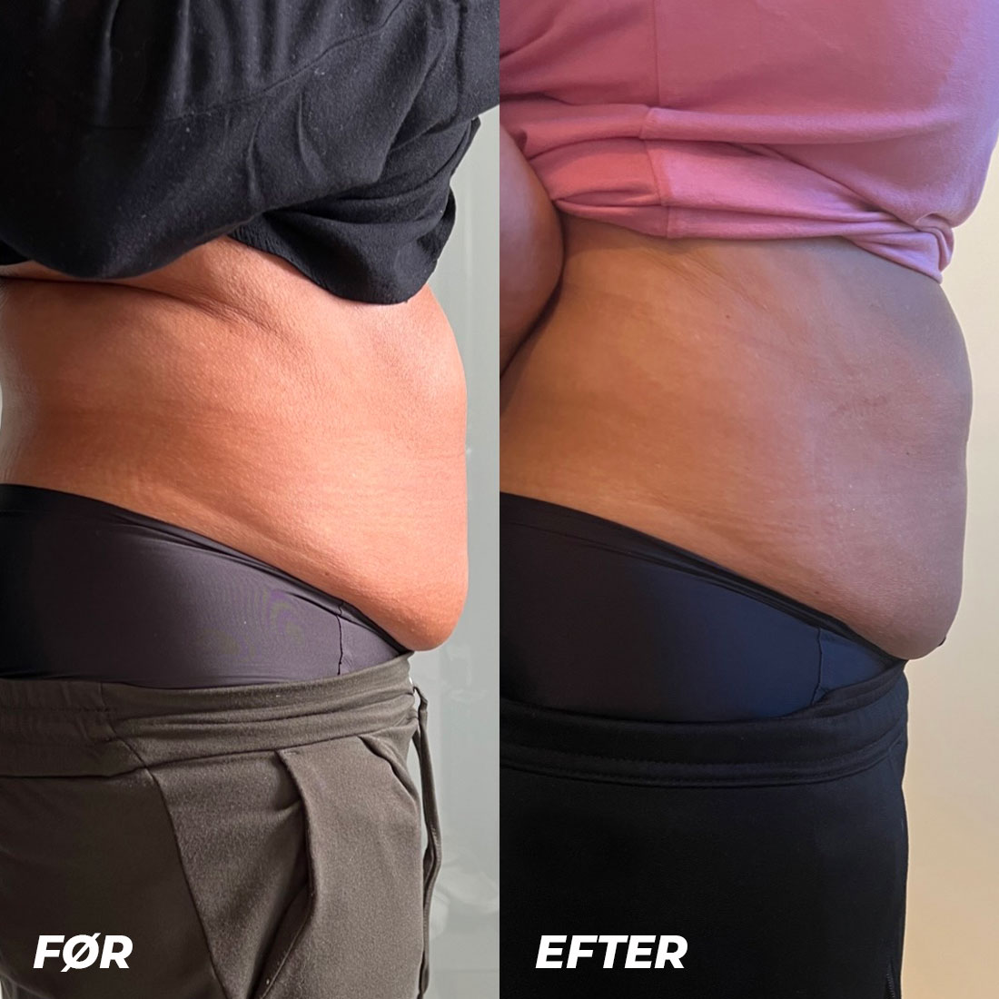 bodysculpting2